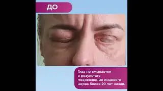 Лагофтальм. Лицевой нерв. Результат лечения