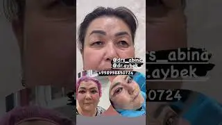 Блефаропластика Век верхней на нижних век до после сразу ￼тема ковок пластикаси +998998850724 200$