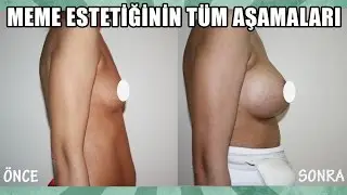Göğüs Estetiği Tüm Aşamaları