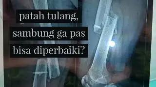 patah tulang paha, nyambung ga pas, bisa diperbaiki