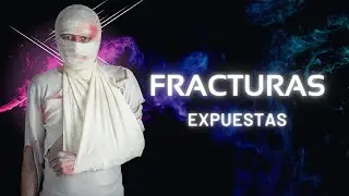 Fracturas expuestas - Lo básico que deberías de saber
