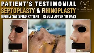 Correction Deviated Septum Septoplasty | Rhinoplasty Nose Before and After Result |Dr Monisha Kapoor