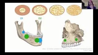 [DUAL TOP] How to Choose Your TAD Screws Based on Evidence By Dr.  Roxana Rugina