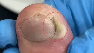 Swelling on one side of the toe, clean the ingrown nail【TD Foot care】