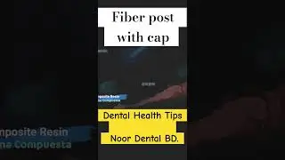 Tooth cap with Fiber post 
