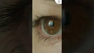 3 Reasons to Wait Before Wearing Colored Contacts After LASIK Surgery By Dr. Tushar Grover