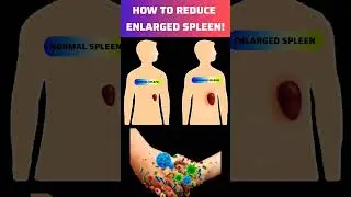 How To Treat Enlarged Spleen | How To Reduced Enlarged Spleen 
