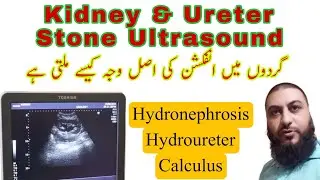 Kidney stone | ureter stone | Hydronephrosis | Hydroureter | Dr Qazi Fahim Shezad