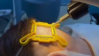 Setting Up The ARTAS Machine | Juvida Clinics