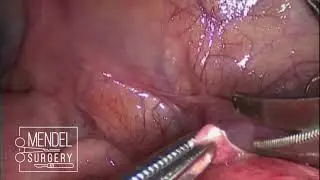 Laparoscopy for intestinal strangulation