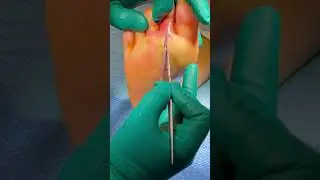 ABSCESS HITS SURGEON IN FACE! GLASSES A MUST!! 