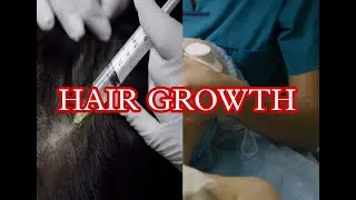 Hair restoration| Hair growth | hair regrowth| Amazing fact | Facts