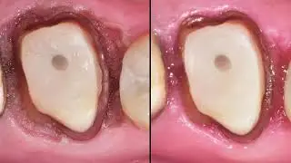 Effective preparation of sulcus for  the impression