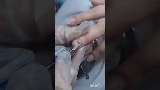 Удаление ногтевой пластины.
