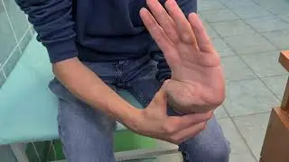 Синдром Элерса - Данлоса (Ehlers— Danlos Syndrome)