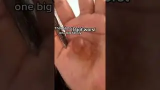 Black head removal on face - Blackheads on back treatment