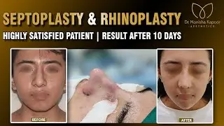 Bulbous Nose to Beautiful Nose Transformation | Rhinoplasty Nose Before & After | Dr Monisha Kapoor