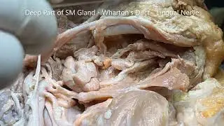 DIGASTRIC Triangle SUBMANDIBULAR GLAND LINGUAL HYPOGLOSSAL FACIAL and Clinicals – Sanjoy Sanyal