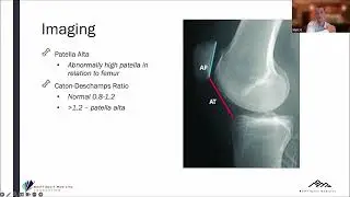 The Management of First-time Patellar Dislocation