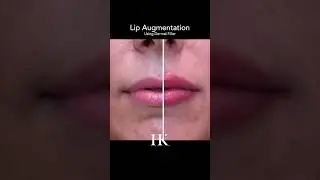 Lip Augmentation with Dermal Filler Before and After by Hooman Khorsani NYC