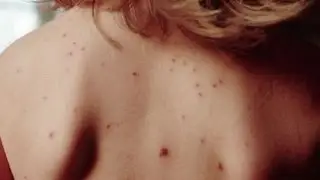 Спина в черных точках