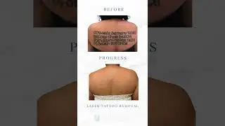 Tattoo Removal