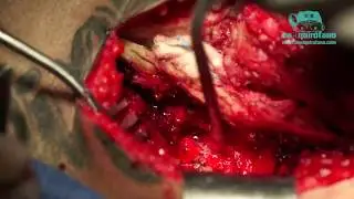 Hernia discal L4-L5