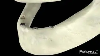 Implantes dentales tratamiento All On Four -Tráiler
