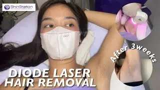 DIODE LASER HAIR REMOVAL | SKINSTATION (1st Session)