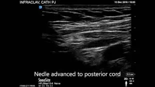 Infraclavicular Brachial Plexus Catheter