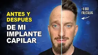 La Operación de Pelo MÁS EXTREMA (+8000 Grafts) | Trasplante Capilar en Turquía - Parte 1