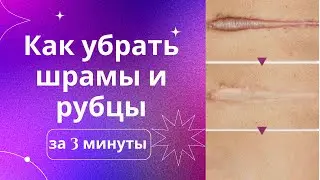 Шрам пропал! Как убрать шрамы и рубцы за 3 мин