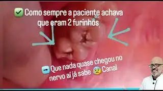 Cárie dentária solução na hora