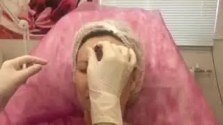 Коррекция морщин Ботокс в клинике Аура