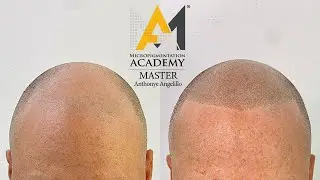 Best Scalp Micropigmentation Results 