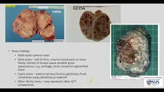 Testis - Teratoma (Gross pathology)