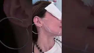 How to Lift Sagging Jowls using Filler | Dr. Khorasani | NYC