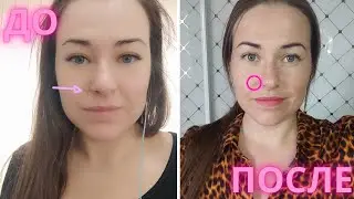 SCARS after MOLE REMOVAL. Is it possible to remove moles on the face?