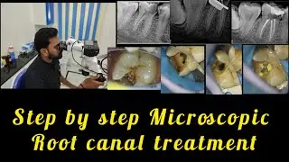 Step by step Microscopic root canal treatment # root canal for beginners