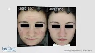 Aerolase Laser   NeoClear Acne Laser Treatment at Laser Skin Clinic