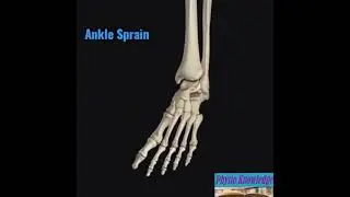 Ankle Sprain & Grades