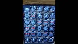 Read MRI Brain 