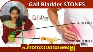 അപകടകാരിയോ ?? Gall Bladder Stone | ഗാൾ ബ്ലാഡർ സ്റ്റോൺ | പിത്താശയ കല്ല്