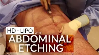 Male Six-Pack Ab Sculpting | 4D VASER Hi-Def Body Sculpting | Abdominal Etching By Dr. Jason Emer
