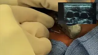 Ultrasound Guided Central Venous Line Placement in the Pediatric Patient