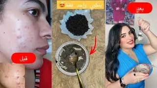 الماسك المعجزة لي غادي يردك قرطاسة وتبكي بالفرحة من النتيجة 🥲😍 #حبوب_الوجه #ماسك_للوجه