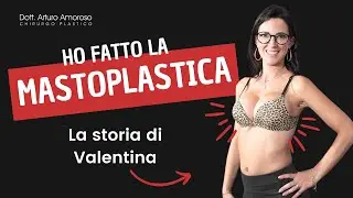 Mastoplastica Additiva: La Storia di Valentina - Dott. Arturo Amoroso