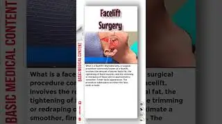 Facelift Surgery 