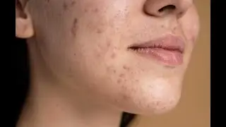 АКНЕ и гормоны