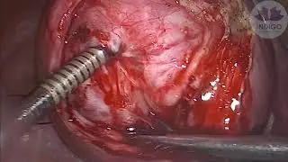Temporary uterine artery ligation for fibroid (no vasopressin)